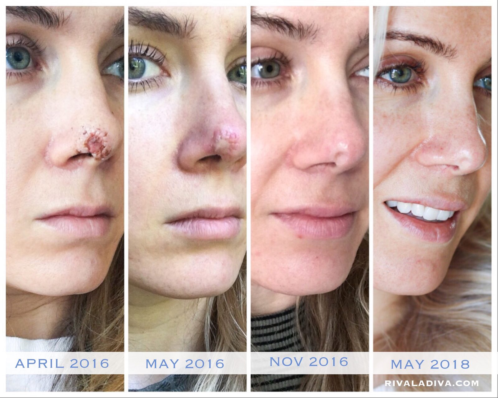SKIN CANCER: 3 things I wish I knew
